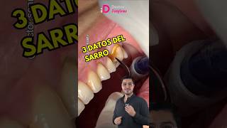 Sarro en los dientes limpiezadental dientesperfectos dientesperfectos shorts dentista [upl. by Ali]