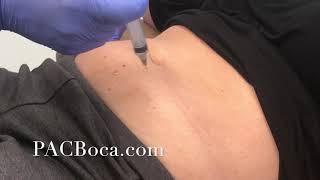 Lipolysis Injections Dr Sharabi PACBocacom [upl. by Litt698]