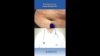 What is melanoma [upl. by Omsoc]