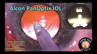 is the Alcon PanOptix trifocal IOL the best choice for cataract surgery [upl. by Pirali]