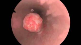 Polypectomy  Polyp Removal  New Features for Virtual Reality Surgical Simulation [upl. by Ycrep626]