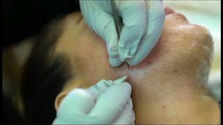 Electrolysis Permanent Hair Removal [upl. by Veal]