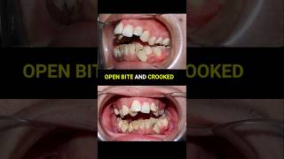 Braces super crooked and openbite teeth braces orthodontist dentist [upl. by Eppesiug]