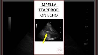 IMPELLA TEARDROP ON ECHOCARDIOGRAM A METALLIC CONE 7mm impellla [upl. by Isej566]