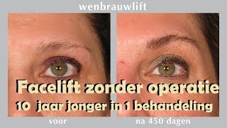 Facelift zonder operatie 10 jaar jonger in 1 behandeling [upl. by Stratton]