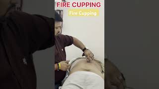 Fire Cupping for Back Pain drmanishgupta spinemanagement accuratehealthcare bestphysiotherapy [upl. by Ahsinauj565]