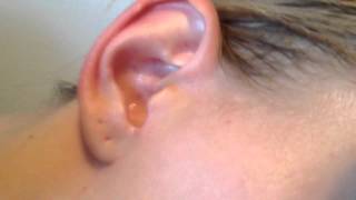 ear  hydrogen peroxide [upl. by Beattie]