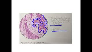 Adenoid cystic carcinoma [upl. by Annovahs231]