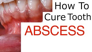 Tooth Abscess Explained [upl. by Eiramoj]