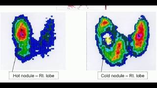 Radiology 11  THYROID SCAN [upl. by Nahshon]