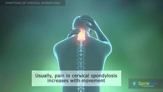 Cervical Spondylosis Symptoms [upl. by Edieh]