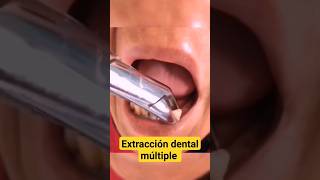 extracción dental múltiple odontologia dentista shorts [upl. by Ynohtna492]