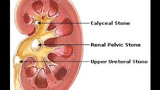 Shockwave sa Bato sa Kidney  ni Dr Ryan Cablitas Urologist 6 [upl. by Hyacinthia715]