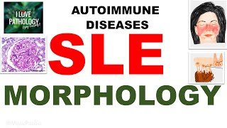 Autoimmune diseases Part 5 Systemic Lupus Erythematosus MORPHOLOGY [upl. by Ecinue]