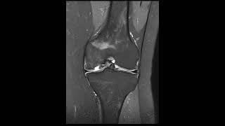 Osteochondritis dissecans [upl. by Poock]