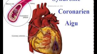 Syndrome coronarien Conduite à Tenir devant une crise cardiaque [upl. by Whale905]