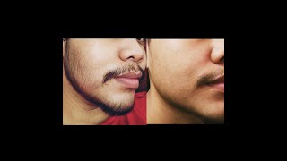 Minoxidil Beard 2 Months Transformation No Genetic [upl. by Akimak]