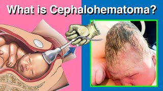 All you need to know about Cephalohematoma [upl. by Haidabez]