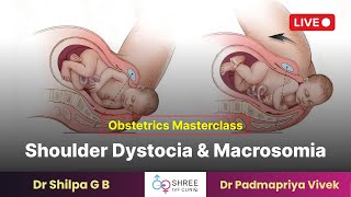 Obstetrics Masterclass Shoulder Dystocia and Macrosomia  Dr Shilpa G B  Dr Padmapriya Vivek [upl. by Drew]