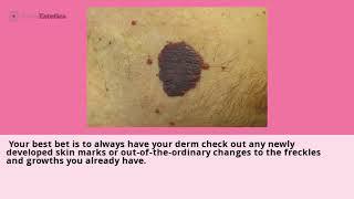 Causes and Risks of Cherry Angiomas aka Red Freckles and Red Moles [upl. by Nick]