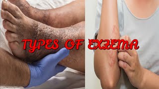 7 TYPES OF ECZEMA YOU NEED TO KNOW [upl. by Candis]