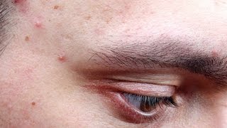 What causes acne and how you can prevent it [upl. by Racso924]