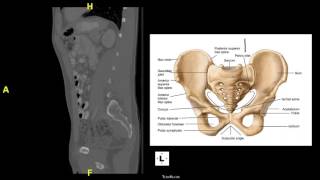 Sagittal CT of Pelvis and Lumbar Spine [upl. by Conyers]