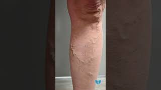 What to Expect During and After a VenaSeal™ Procedure for Varicose Vein Treatment [upl. by Ailefo]