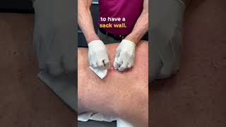 Pop Goes the Cyst skincare pimplepopper cystpoping [upl. by Nivalc783]