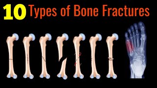 10 Most Common Bone Fractures Animated Explanations [upl. by Nilre]