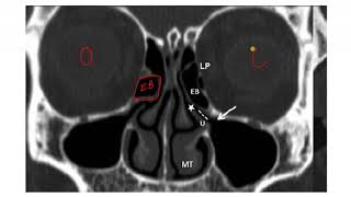 OMC OSTEOMEATAL UNIT PNS MAXILLARY SINUS RADIOLOGY CT ANATOMY [upl. by Joed]