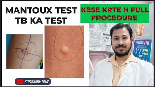 mantoux test full description mantoux test result in hindi [upl. by Hpseoj]