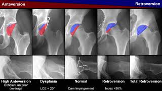 S Steppacher Pelvic incidence in acetabular retroversion Hip Symposium 2018 [upl. by Hildebrandt613]