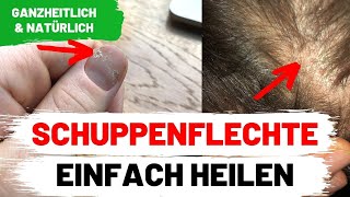 Schuppenflechte heilen  So habe ich es geschafft  Psoriasis Vulgaris Nägel Arthritis [upl. by Awhsoj660]