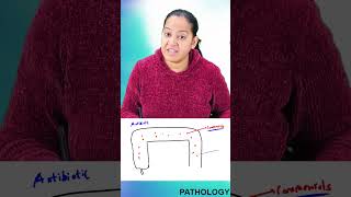 1 minute learning Pseudomembrane colitis or Antibiotic associated colitis [upl. by Ayidah]