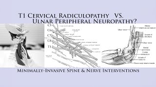 How to Differentiate T1 Cervical Radiculopathy vs Ulnar Nerve Neuropathy Cubital Tunnel Syndrome [upl. by Yrrok]