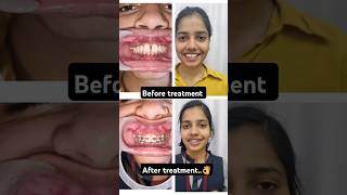 Midline diastema gaps in front tooth frenectomy Drswetakaushik orthodontist dentist [upl. by Cowey]