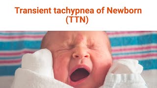 Transient Tachypnea of the Newborn [upl. by Witha600]