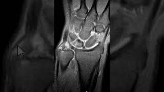 Triangular fibrocartilage TFCC tear wrist MRI [upl. by Eanaj]