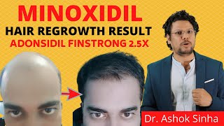 Minoxidil Hair Regrowth Results 😳 क्या सही मै हेयर रिग्रोथ हुवा Adonsidil Result [upl. by Haianeb]