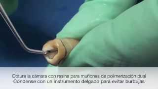 Cementación de postes prefabricados en dientes con endodoncia [upl. by Forkey]