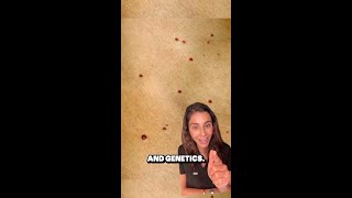 What is Cherry Angiomas [upl. by Aeslehs]