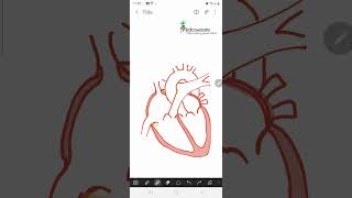 Constrictive Pericarditis  ventricular discordance expiratory hepatic vein flow reversal [upl. by Herrah]