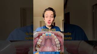 CE QU’ON TE DIT PAS SUR L’APPAREIL DENTAIRE 🦷 dentiste orthodontie appareildentaire dent [upl. by Aniat788]