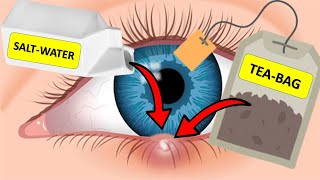 How To Get Rid of a Stye Overnight USING SALTWATER amp TEABAGS [upl. by Mauchi]