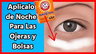 ¿Qué tipos de ojeras existen y cómo se eliminan [upl. by Eninahs]