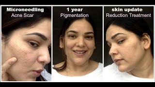 Microneedling 1 Year skin Update Acne scar reduction pigmentation old age wrinkles treatment [upl. by Polard]