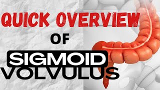 QUICK OVERVIEW of Sigmoid Volvulus [upl. by Alyakem]