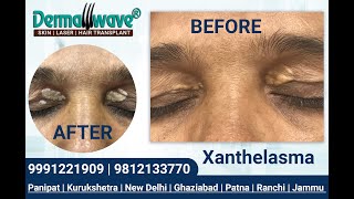 Xanthelasma Treatment  Dermawave Skin Clinic Panipat  Patna  Jammu  Kurukshetra  New Delhi [upl. by Lull]