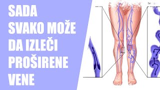 ⚫ Preparati za proširene vene na nogama masti i gelovi 🚫 [upl. by Yvette]